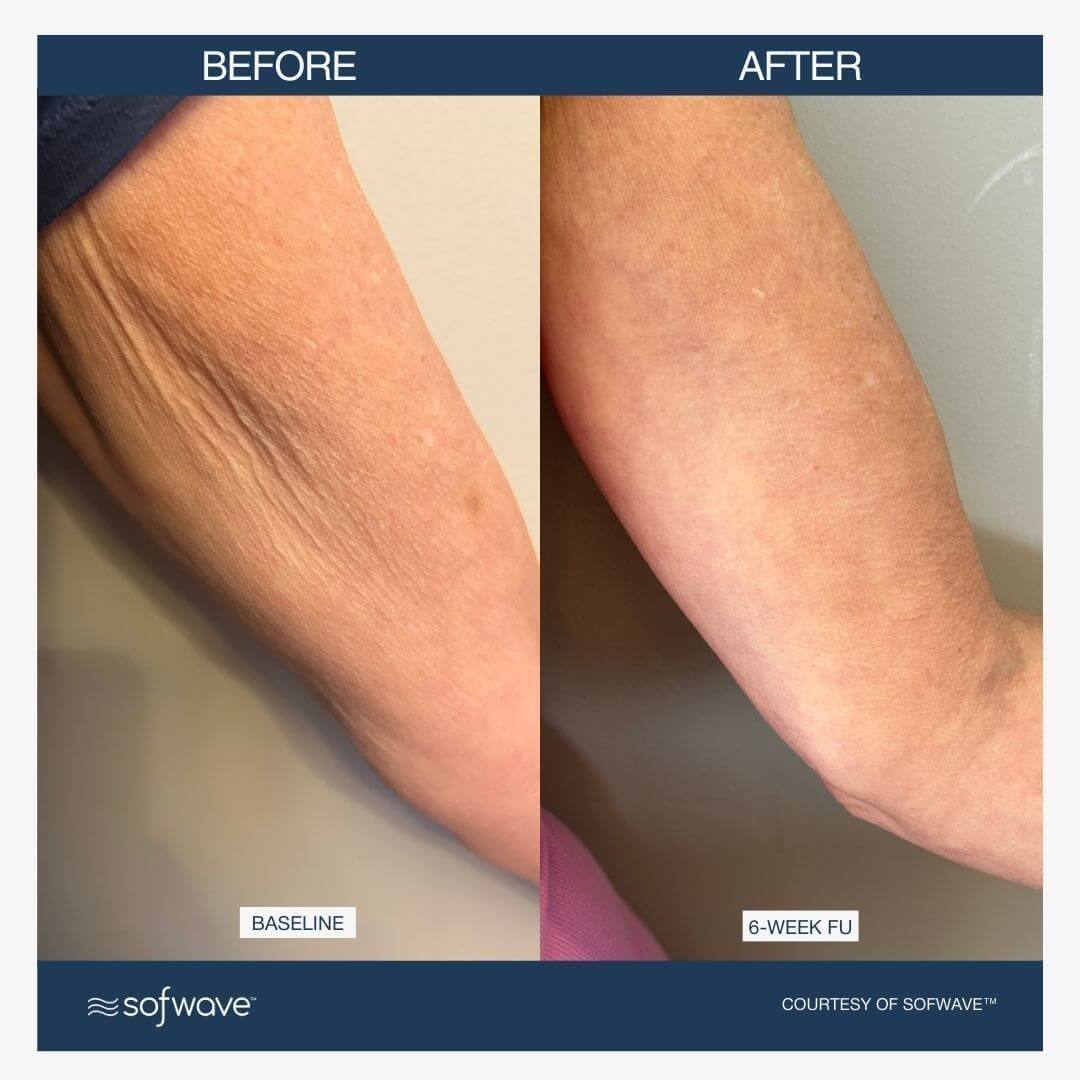 Sofwave for upper arms skin laxity