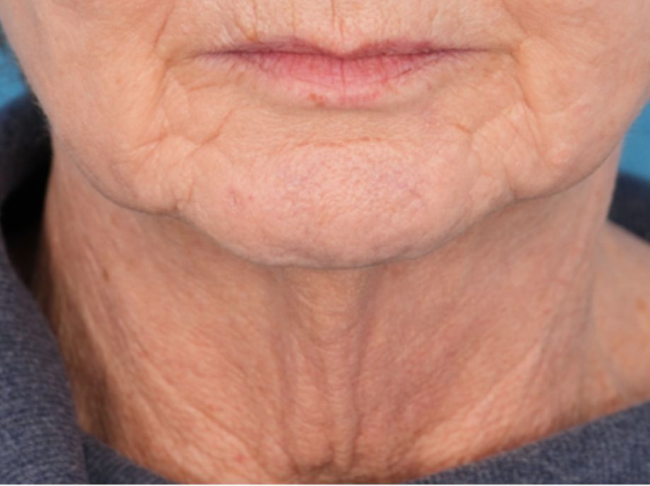 Chicago Oculofacial Plastic Surgery neck before