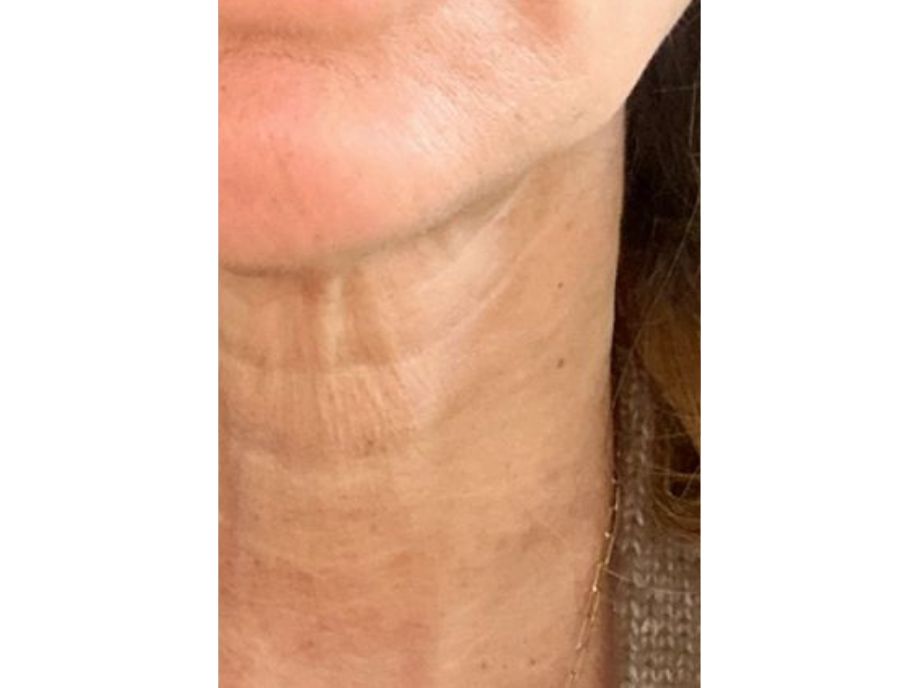 Neck, Beaute Aesthetics, After 2 months