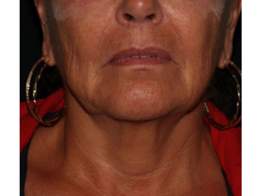 Neck, Renew Medispa, After 6 months