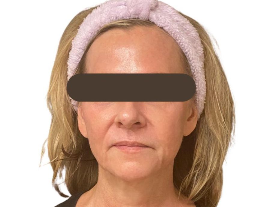 Face Des Moines Plastic Surgery after