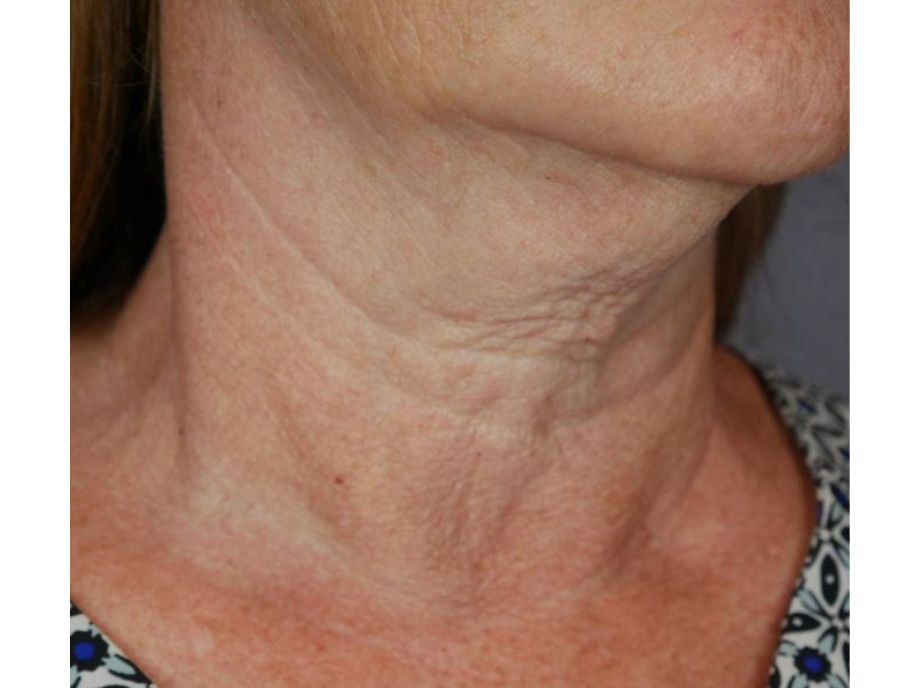 Neck Charmed Medispa before