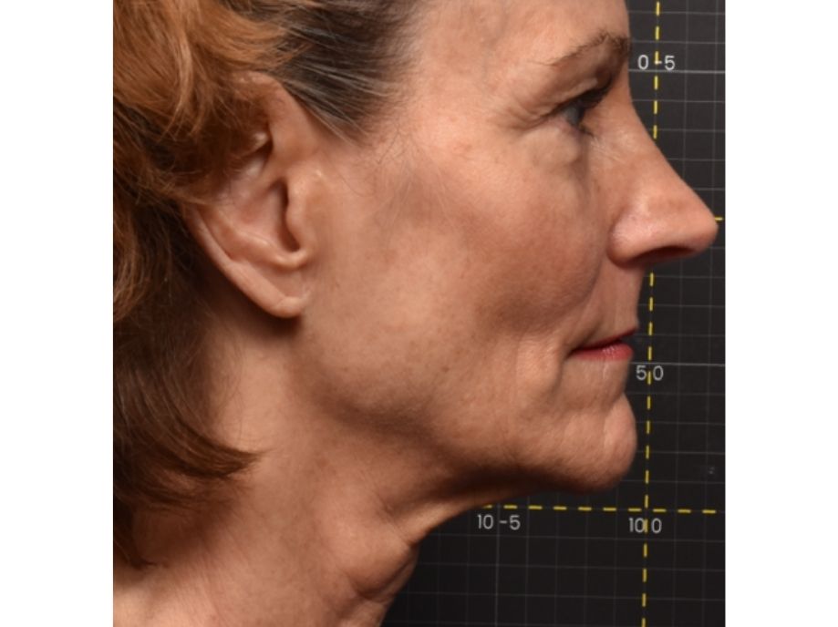 face wrinkles reduction side after 4 months Gilly Munavalli 9