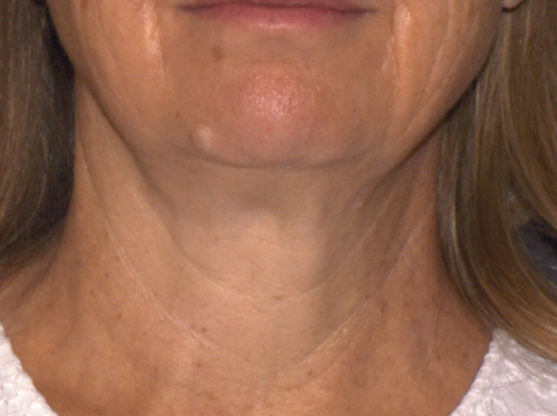 after 4 months Sofwave neck lift by Suzanne Kilmer MD