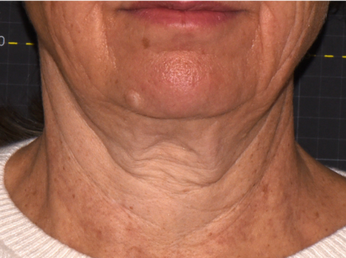 before 4 months Sofwave neck lift by Suzanne Kilmer MD