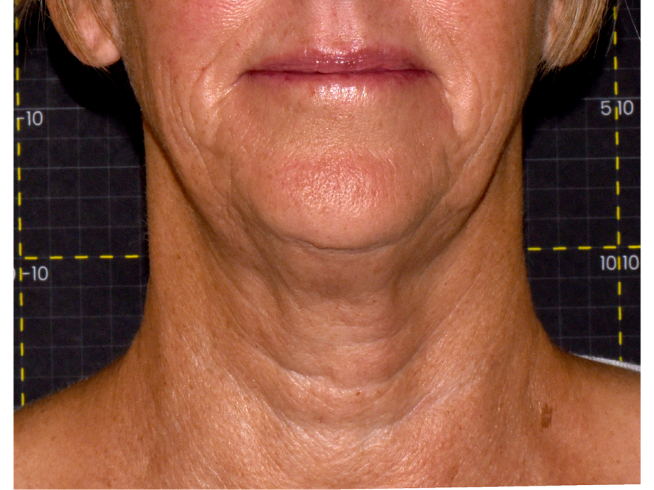 after 15 weeks Sofwave neck lifting by Kilmer MD