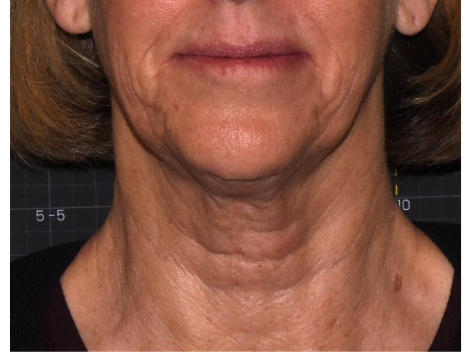 before 15 weeks neck lifting by Suzanne Kilmer MD