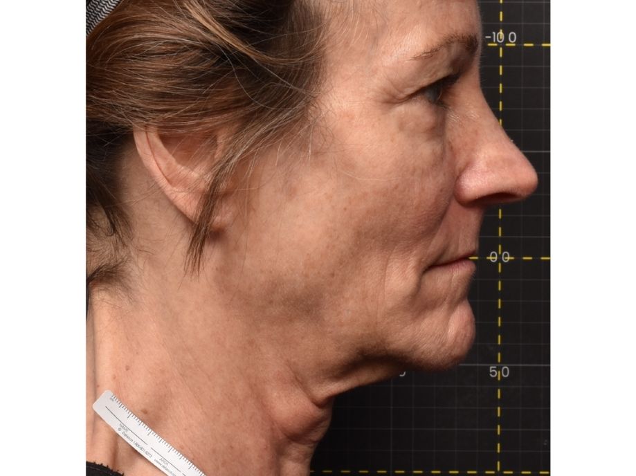 face wrinkles reduction before side Gilly Munavalli 9