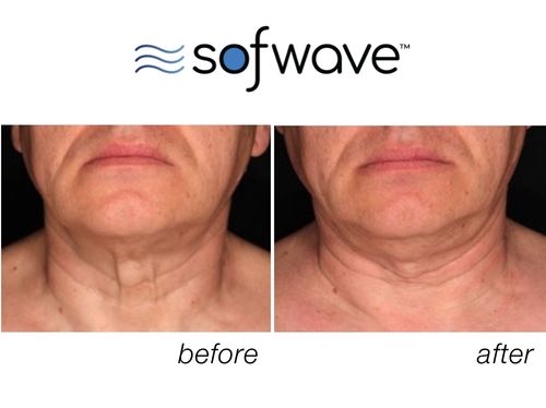 How safe is Sofwave™ technology