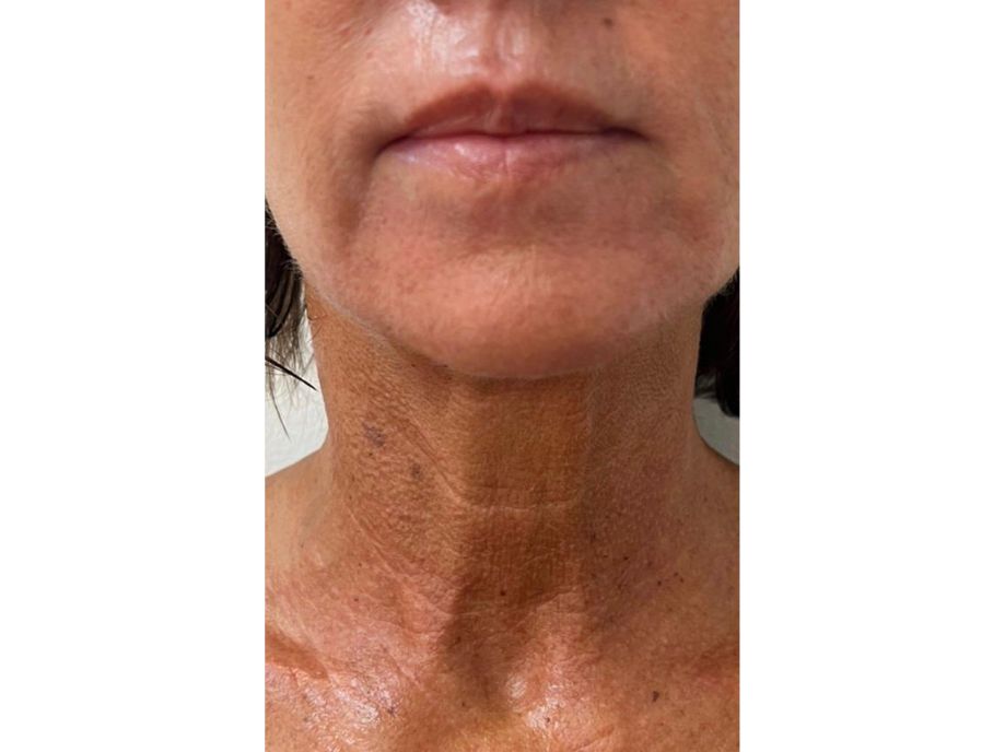 AMY LEWIS, MD neck after
