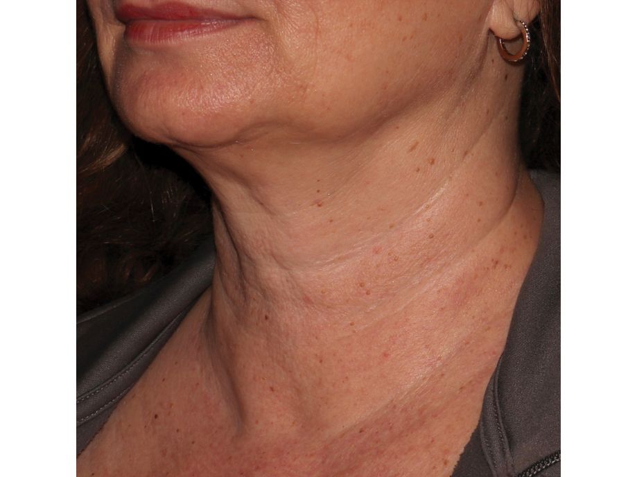 Amy Forman Taub, MD after neck 2