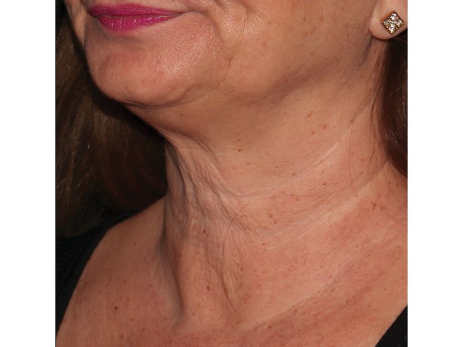 Amy Forman Taub, MD before neck 2