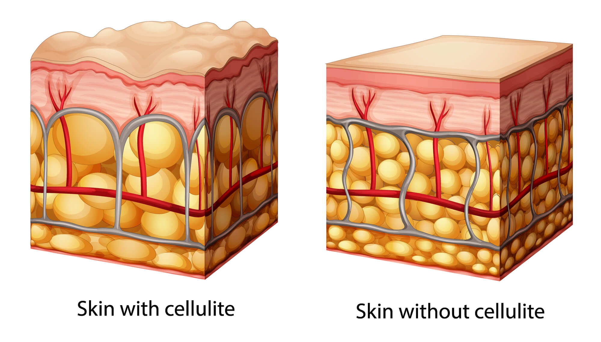 What exactly is cellulite?