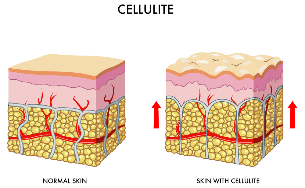 Why does cellulite develop on the thighs?