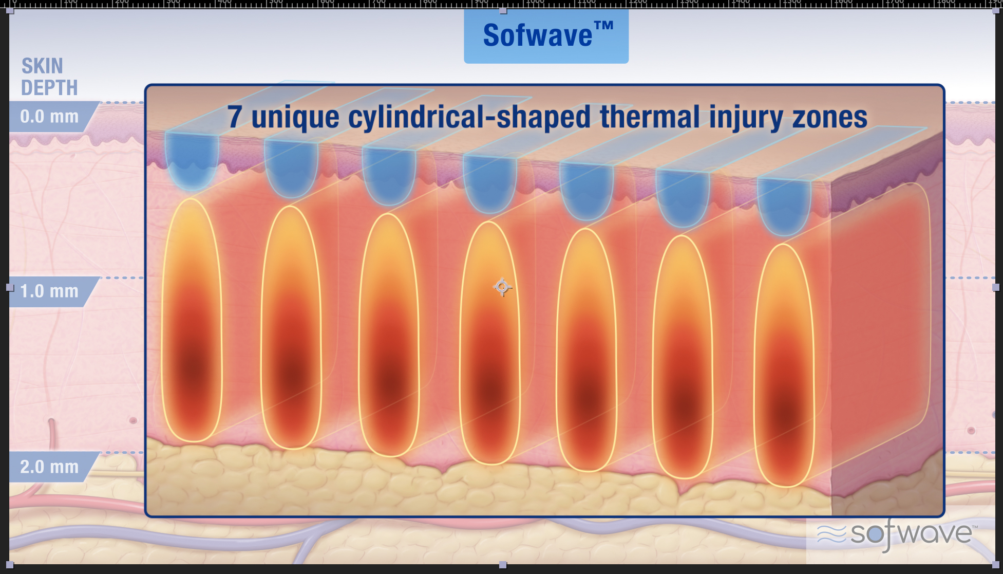 Sofwave™ Superb™ Technology - A Comparative Review