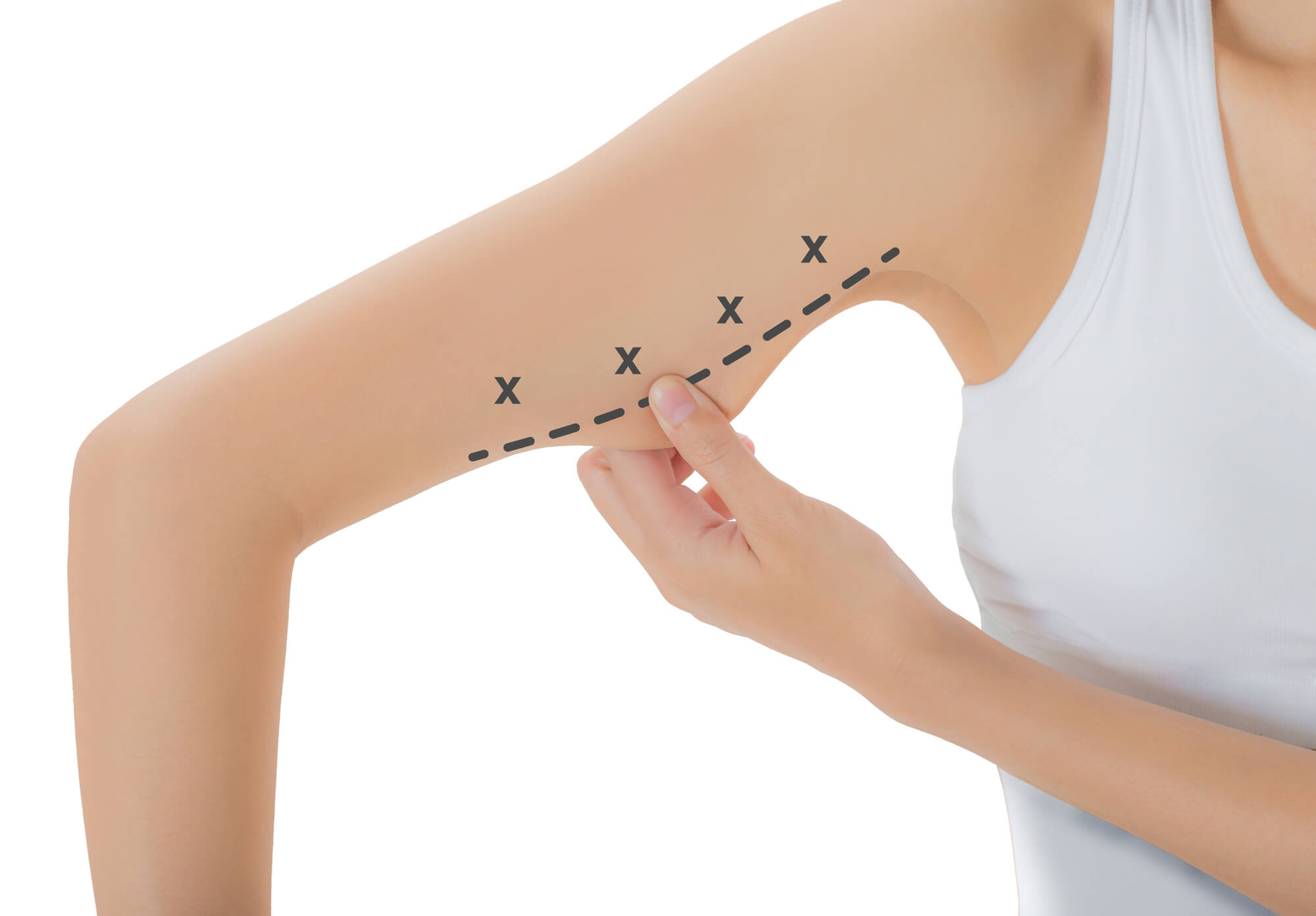 Brachioplasty Procedure (Arm Lift Surgery)