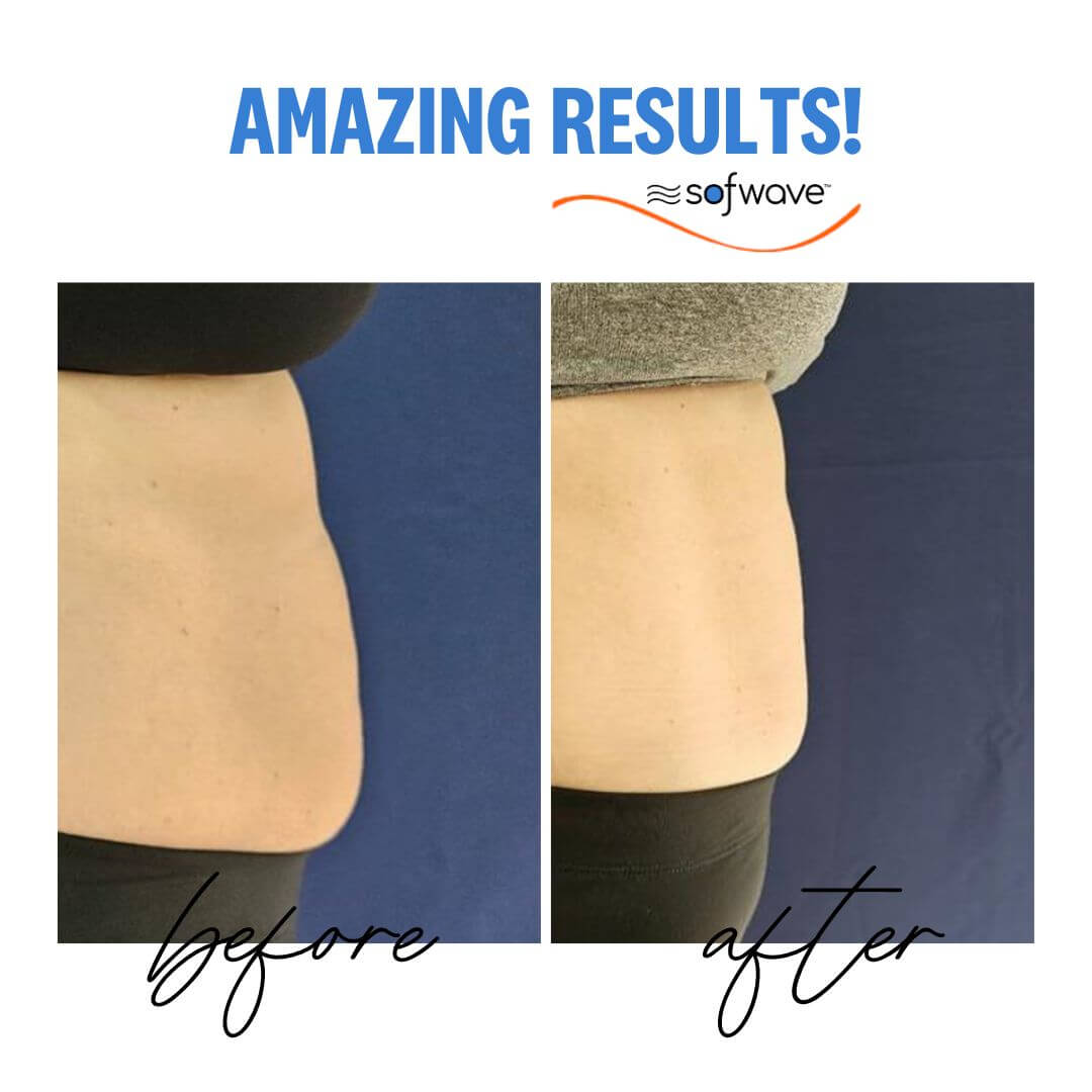 Before and After Pure Impact body sculpting